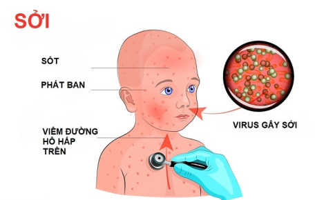 Tổ chức thực hiện chiến dịch tiêm chủng vắc xin phòng chống dịch sởi